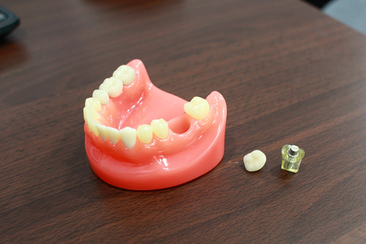 違和感がない！まるで自分の歯のようなインプラントを提供します